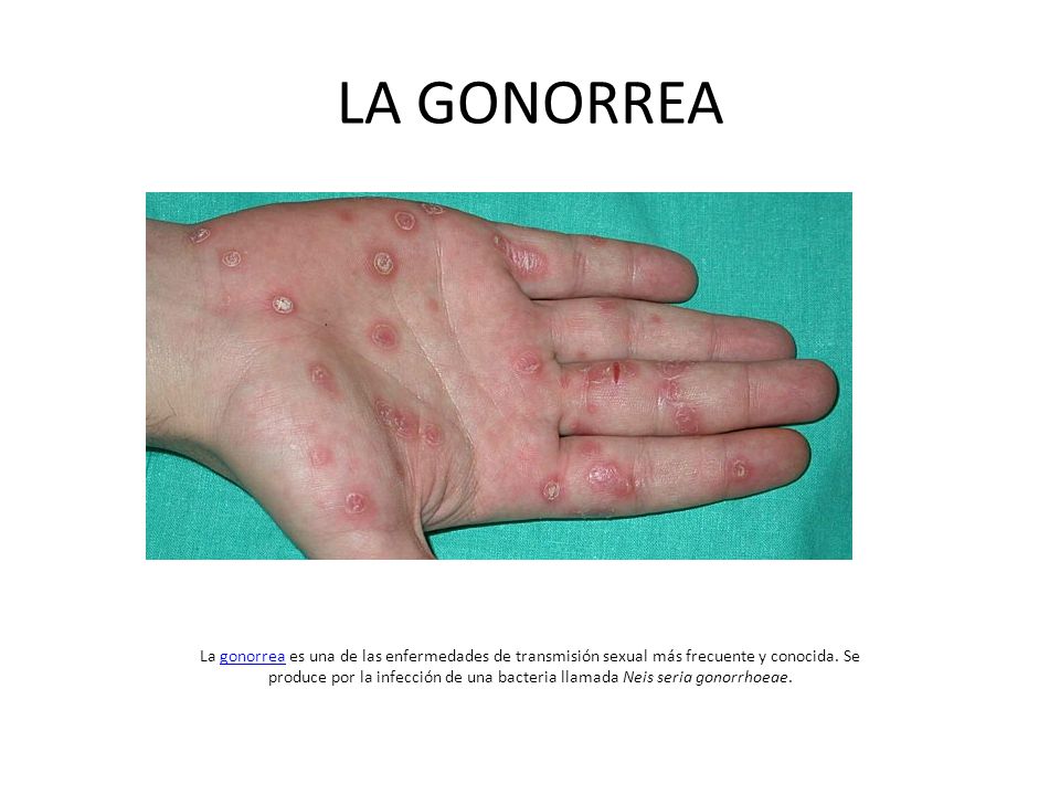 Gonorrea enfermedades transmision sexualidad